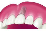 Ersetzen einzelner Zähne